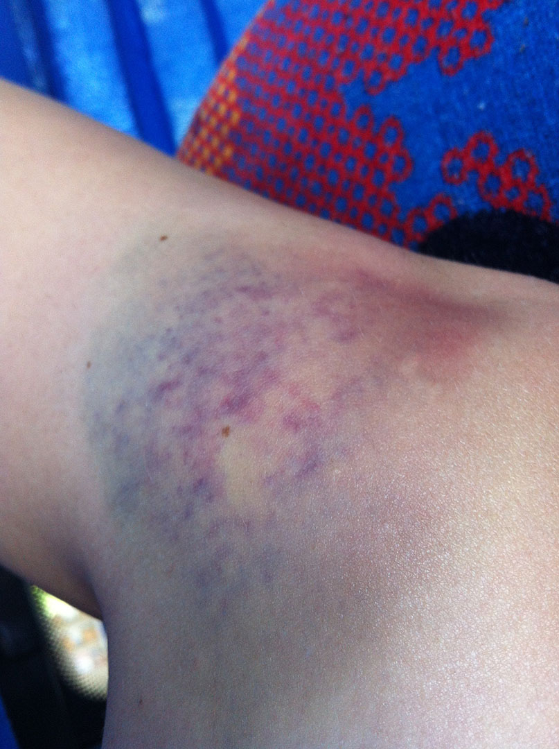 My blue, green and purple bruised knee after being mugged by two motorcyclists in Hurghada, Egypt