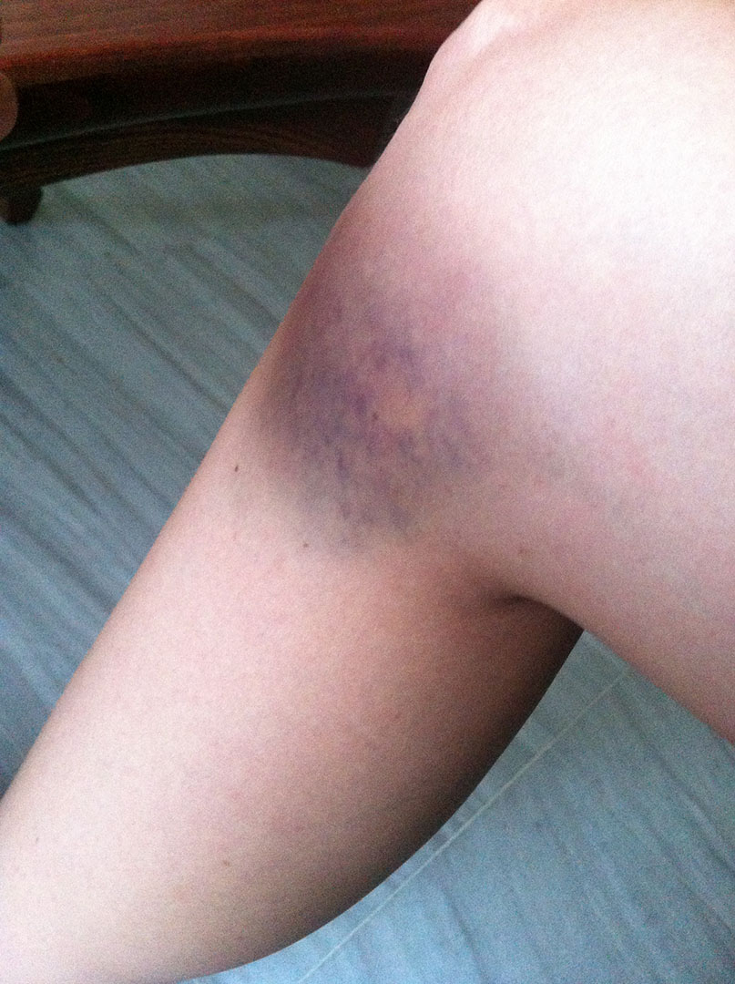 My blue, green and purple bruised knee after being mugged by two motorcyclists in Hurghada, Egypt