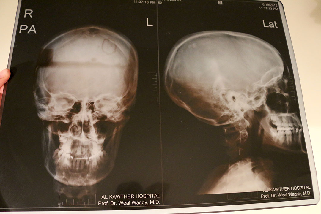 My skull x-rays after being mugged in Hurghada, Egypt and hitting my head hard on the road