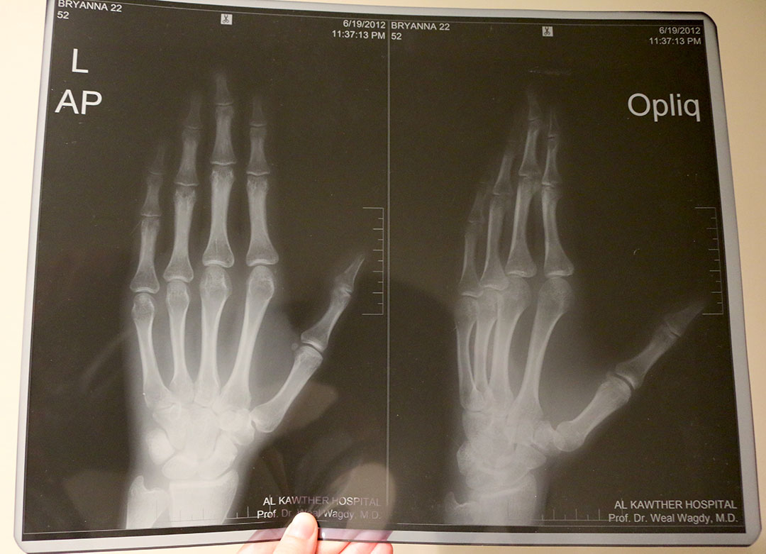 My hand x-rays after being mugged in Hurghada, Egypt and hitting my hand hard on the road